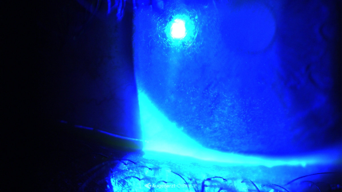 Punctate epithelial erosions